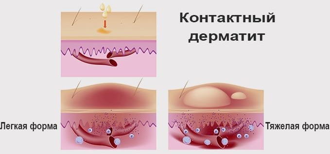 Фурацилин при цистите в таблетках. Инструкция по применению