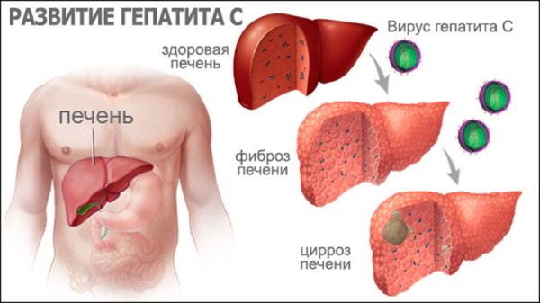 Гепатит С (Вирусный гепатит С): всё о заболевании, как передается, лечится