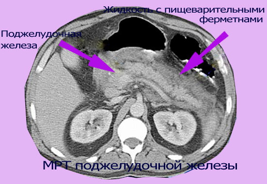 Холецистопанкреатит. Симптомы и лечение у взрослых, питание