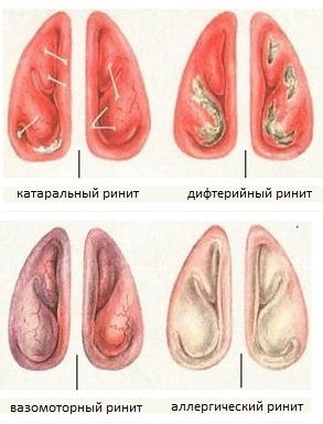 Хронический ринит. Лечение у взрослых, препараты, антибиотики