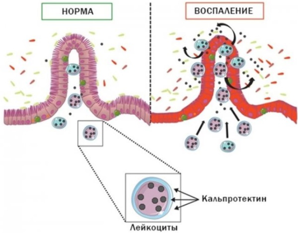 Кальпротектин фекальный в гемотесте. Норма у взрослых, детей, что значит повышен, понижен