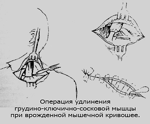 Операция при кривошее