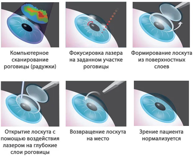 Лазерная коррекция зрения. Где лучше делать в Москве. Рейтинг клиник