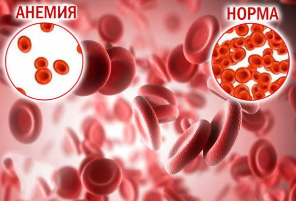 Малокровие у женщин. Симптомы, причины, лечение