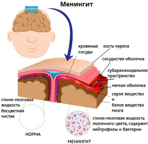 Менингит у взрослых. Лечение, препараты, антибиотики