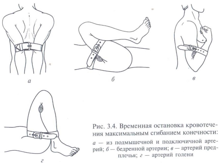 Наложение жгута при артериальном кровотечении. Алгоритм действий на предплечье, бедро, плечо