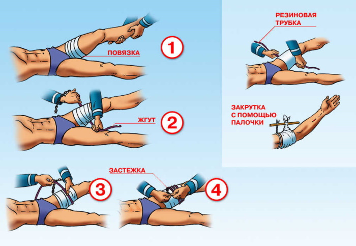 Наложение жгута при артериальном кровотечении. Алгоритм действий на предплечье, бедро, плечо