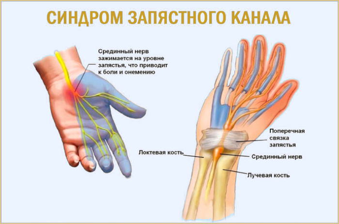 Немеют руки и ноги и бегают мурашки. Причины и лечение