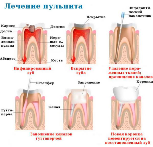 Нерв в зубе. Где находится, фото, воспаление, удаление