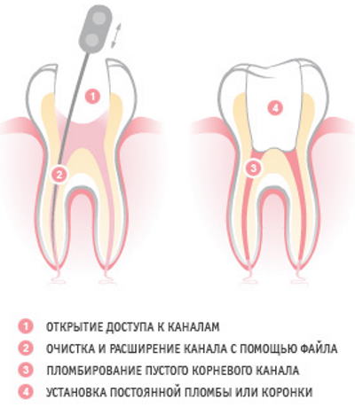 Нерв в зубе. Где находится, фото, воспаление, удаление