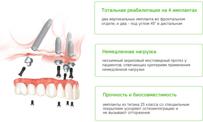 Несъемный протез на 4 имплантах. Цена, можно ли поставить