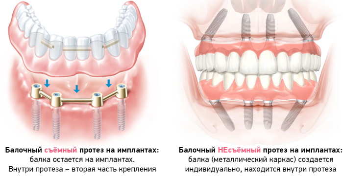 Несъемный протез на 4 имплантах. Цена, можно ли поставить