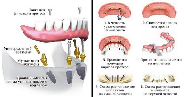 Несъемный протез на 4 имплантах. Цена, можно ли поставить