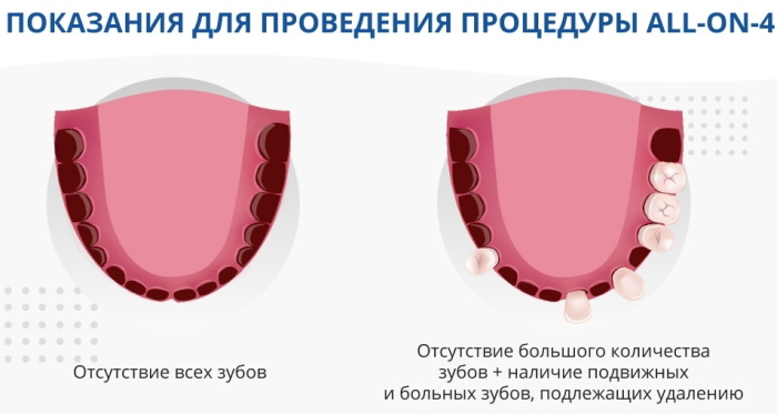 Несъемный протез на 4 имплантах. Цена, можно ли поставить