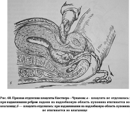 Отделение плаценты. Признаки по авторам Альфельду, Кюстнеру-Чукалову