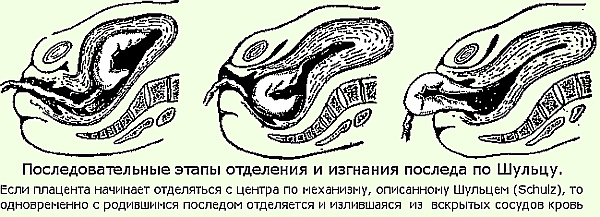 Отделение плаценты. Признаки по авторам Альфельду, Кюстнеру-Чукалову