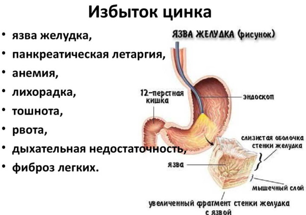 Переизбыток цинка в организме Симптомы у женщин, мужчин, детей