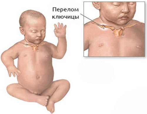 Перелом ключицы у ребенка 2 года без смещения. Лечение