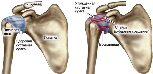 Плечелопаточный периартрит. Лечение медикаментозное, ЛФК, препараты