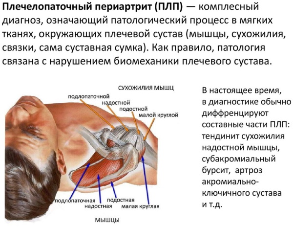 Плечелопаточный периартрит. Лечение медикаментозное, ЛФК, препараты