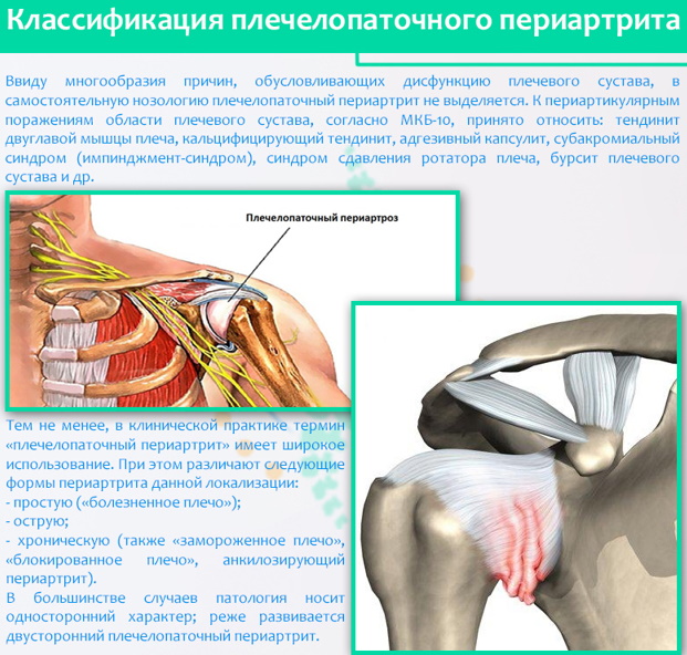 Плечелопаточный периартрит. Лечение медикаментозное, ЛФК, препараты