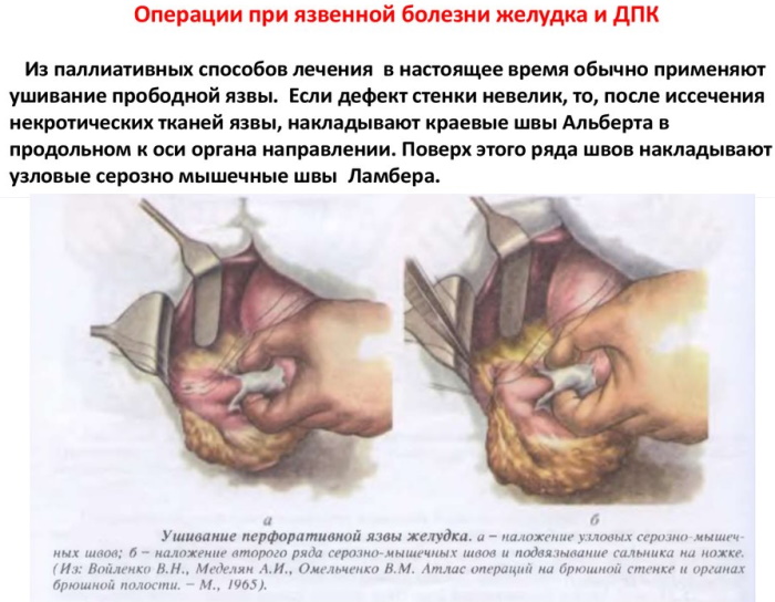 Поверхностный гастрит. Симптомы и лечение у женщин, диета