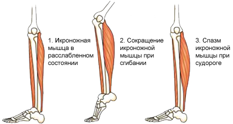 Спазмы мышц по всему телу. Причины и лечение