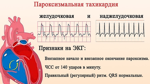 Тахикардия сердца. Причины возникновения, симптомы и лечение