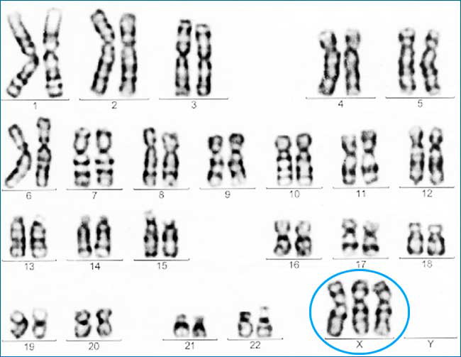 Трисомия по X-хромосоме синдром. Причины, диагностика, лечение