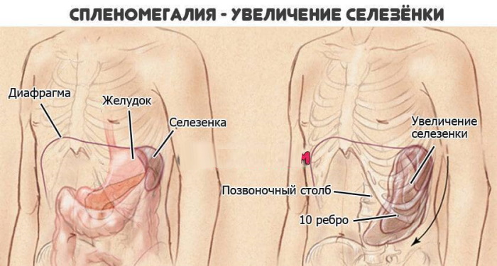 Заболевания селезенки. Симптомы и лечение у женщин, мужчин