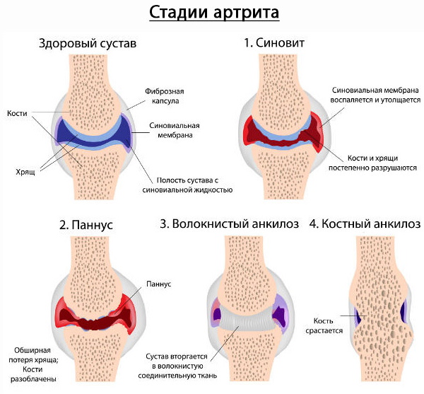 Артрит колена. Лечение 1-2 степени, препараты, мази