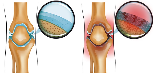 Артрит колена. Лечение 1-2 степени, препараты, мази