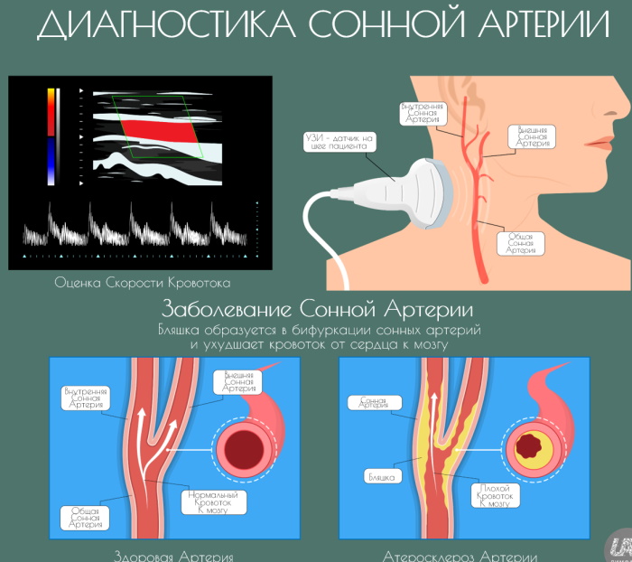 Атеросклероз сосудов шеи, головы. Симптомы и лечение