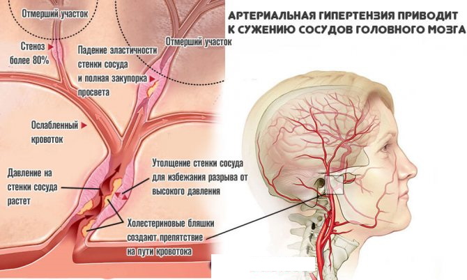 Атеросклероз сосудов шеи, головы. Симптомы и лечение