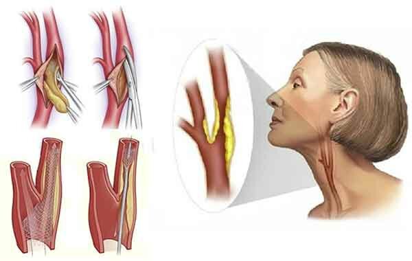 Атеросклероз сосудов шеи, головы. Симптомы и лечение