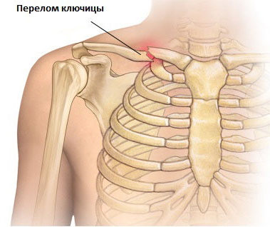 Боль в ключице слева, справа. Причины у женщин, мужчин