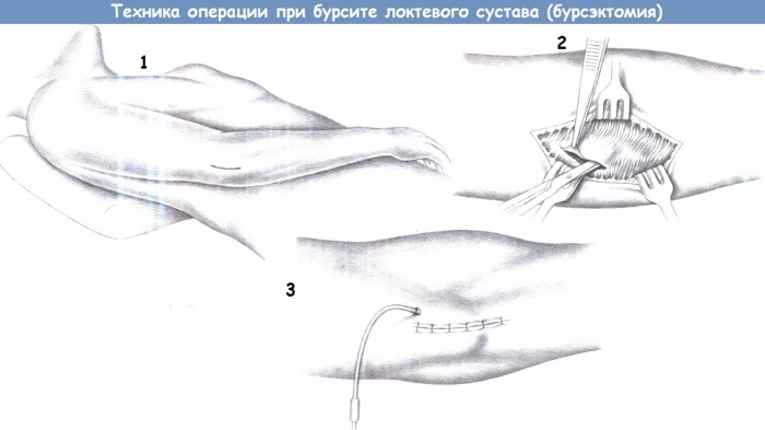 Боли в предплечье правой руки. Причины и что делать