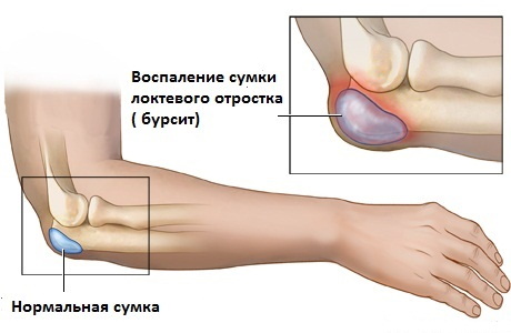 Боли в предплечье правой руки. Причины и что делать