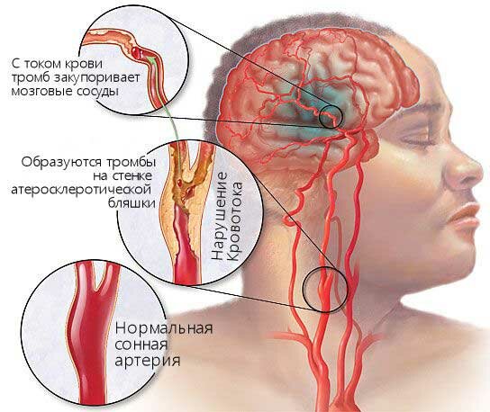 Боль во лбу над переносицей, в глазах, при наклоне. Причины