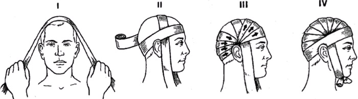 Чепец повязка на голову. Алгоритм, техника выполнения, показания