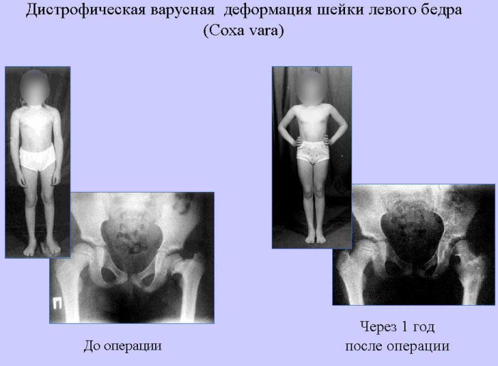 Coxa Valga у детей. Что это такое, лечение