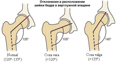 Coxa Valga у детей. Что это такое, лечение