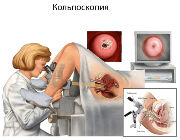 Длинная шейка матки перед родами. Что делать