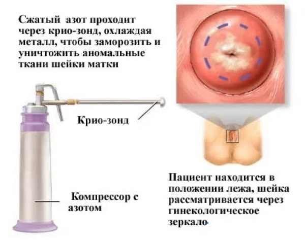 Длинная шейка матки перед родами. Что делать