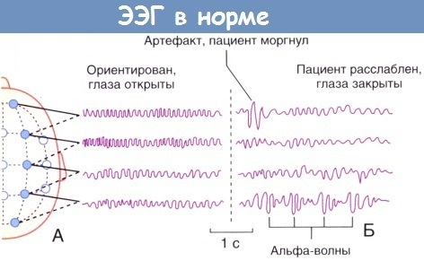 ЭЭГ (электроэнцефалография) у детей. Норма и нарушения, расшифровка