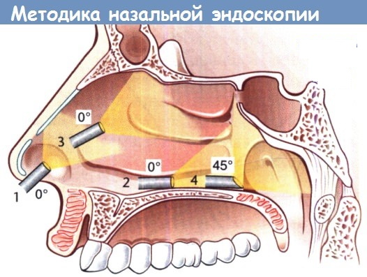 Эндоскопия носоглотки детям. Как делают, цена, отзывы