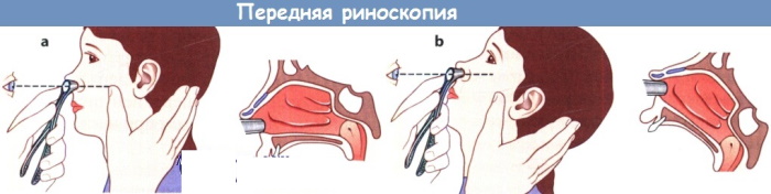 Эндоскопия носоглотки детям. Как делают, цена, отзывы