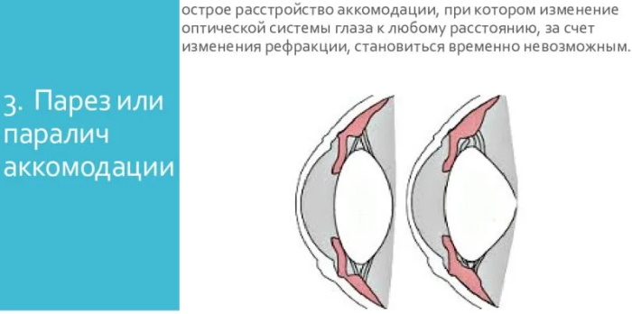 Нарушение аккомодации глаза у детей. Что это такое