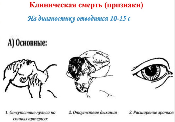 Остановка кровообращения. Клинические признаки