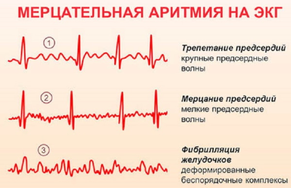 Перебои в сердце. Причины, что делать, отзывы врачей